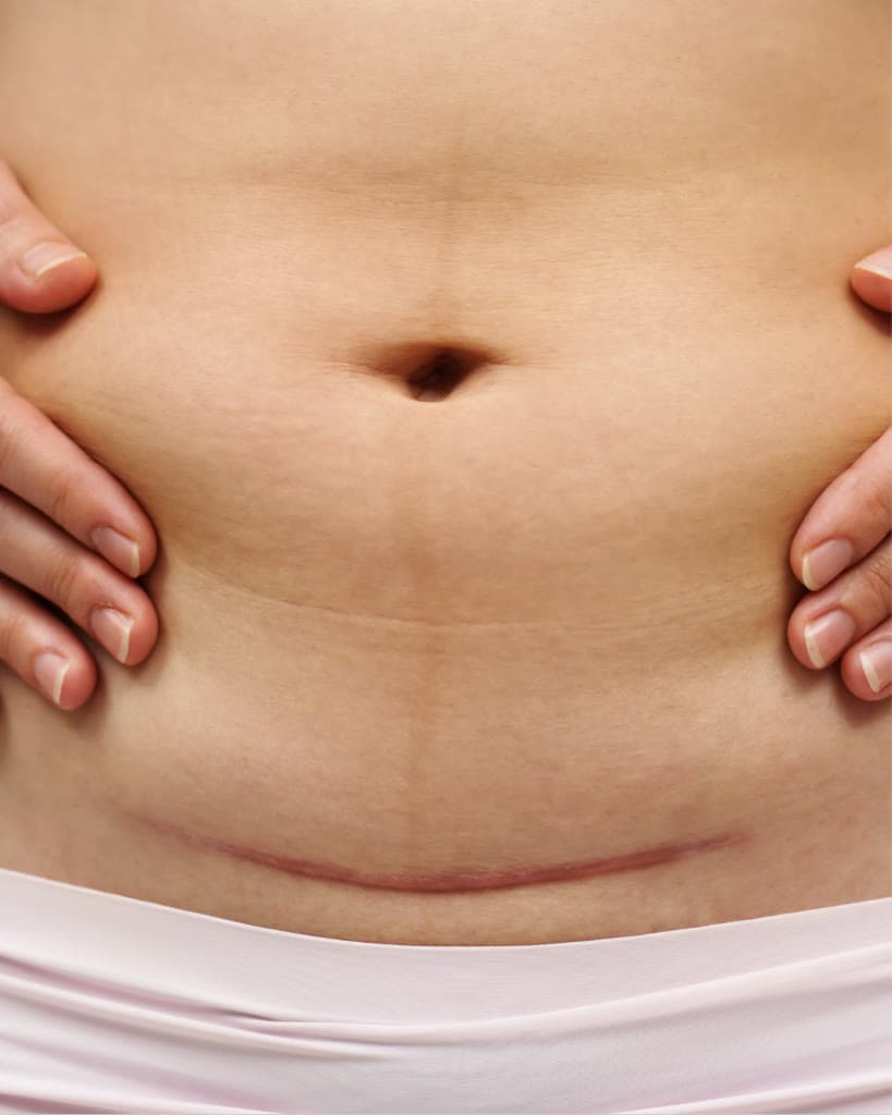 Cesarean Scar Treatment: How PRP Can Transform Your C-Section Scar Naturally
