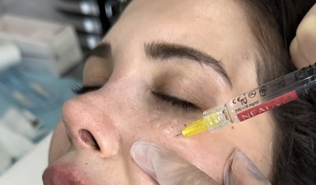 Neauvia Hydro Deluxe: A Skin Booster for Deep Hydration and Collagen Stimulation