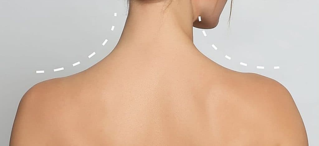 Trap Treatment: For a Sculpted Neck and Slimmer Shoulders, from £395
