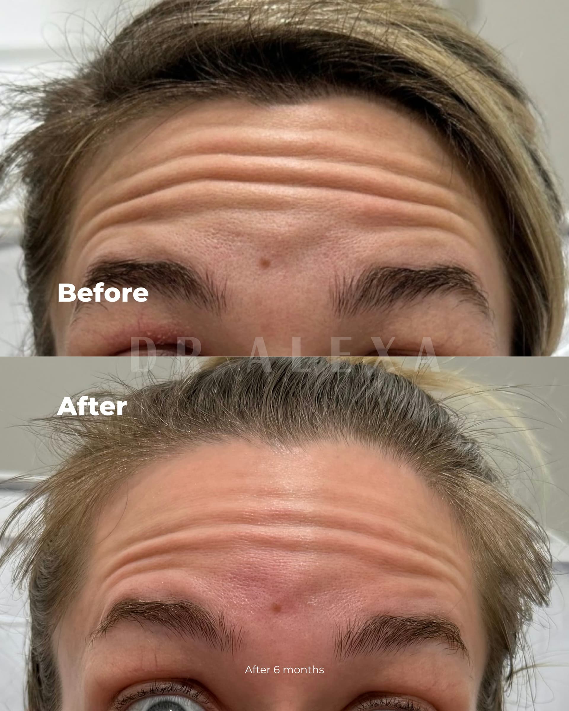 Alluzience before and after — case 1, Dr Alexa Mayfair