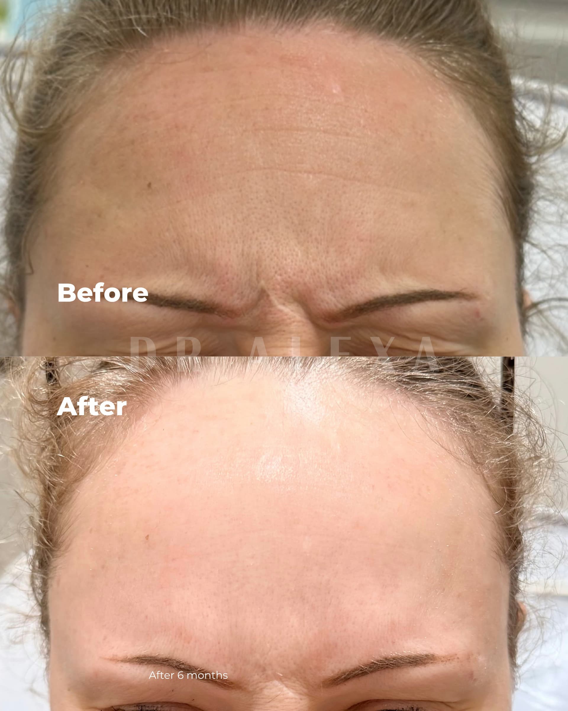 Alluzience before and after — case 2, Dr Alexa Mayfair