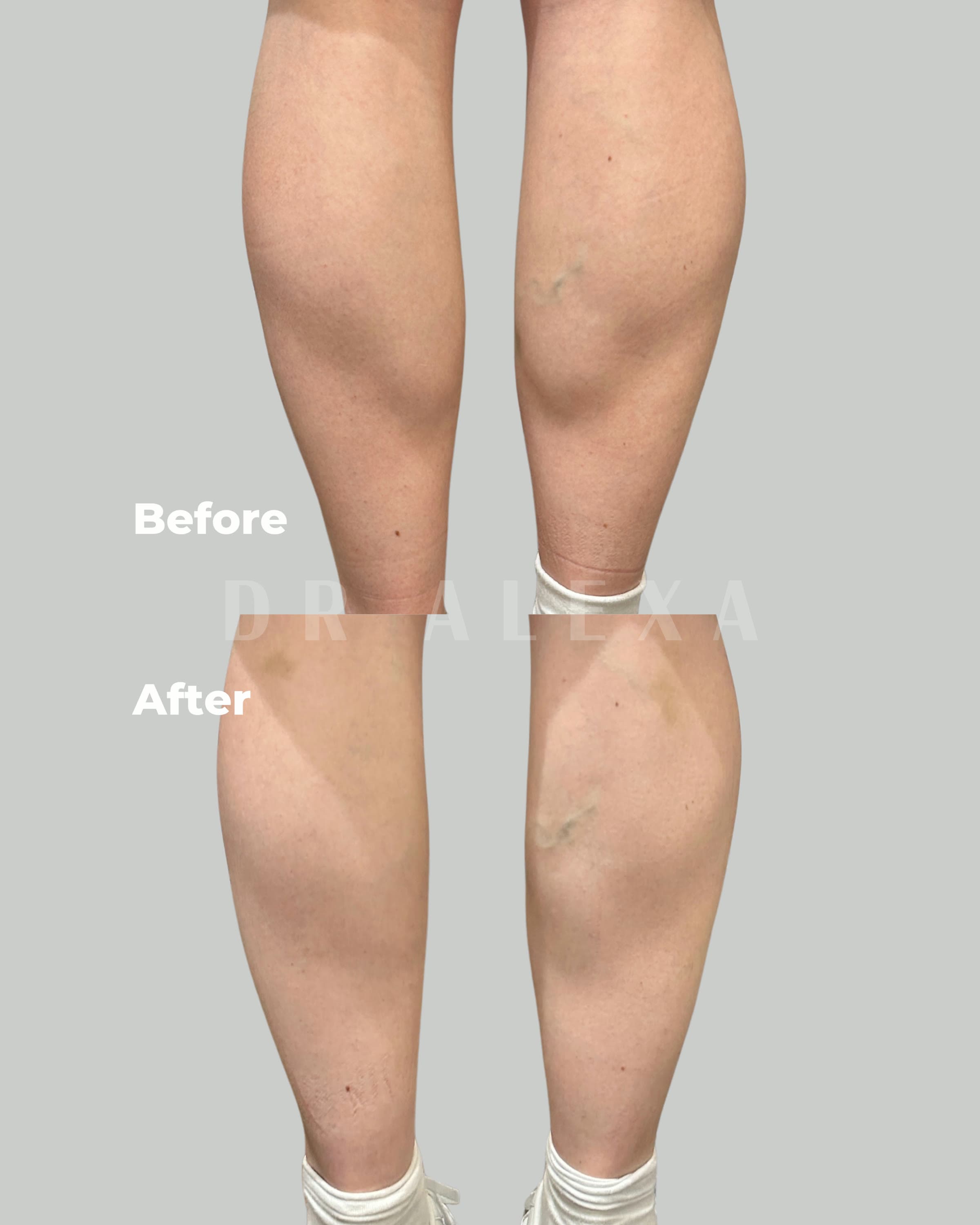 Calf Slimming before and after — case 1, Dr Alexa Mayfair