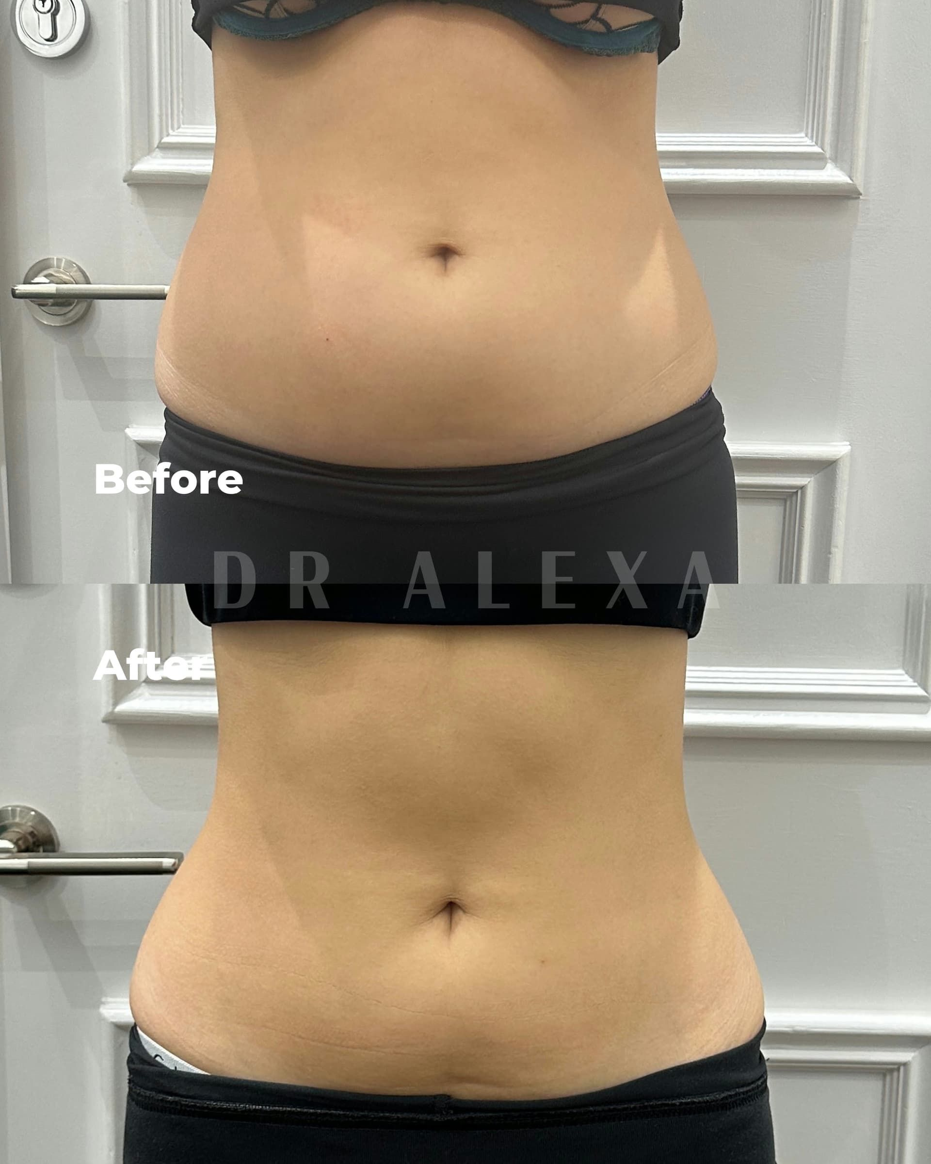 Fat Dissolving before and after — case 1, Dr Alexa Mayfair