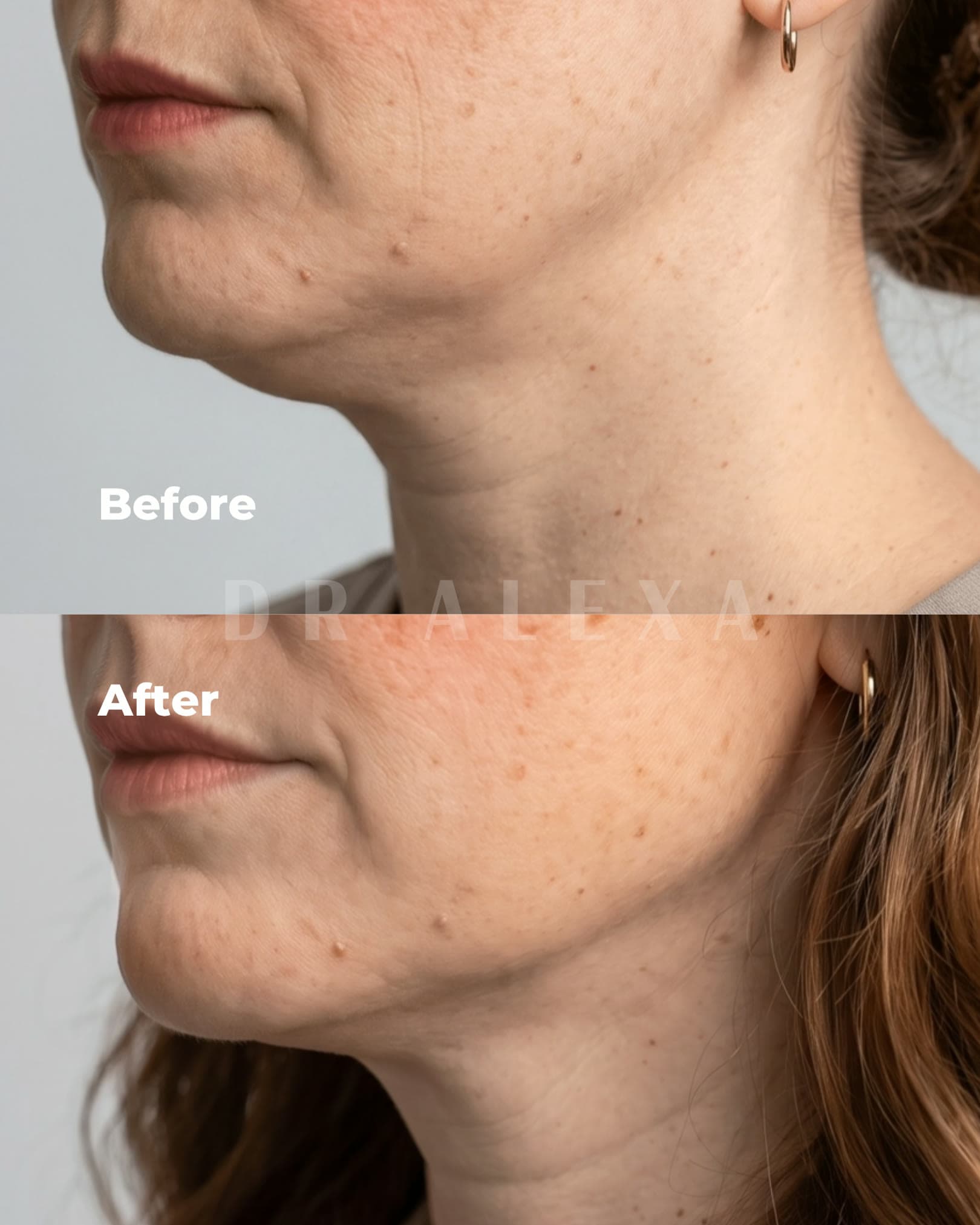 Fat Dissolving before and after — case 2, Dr Alexa Mayfair