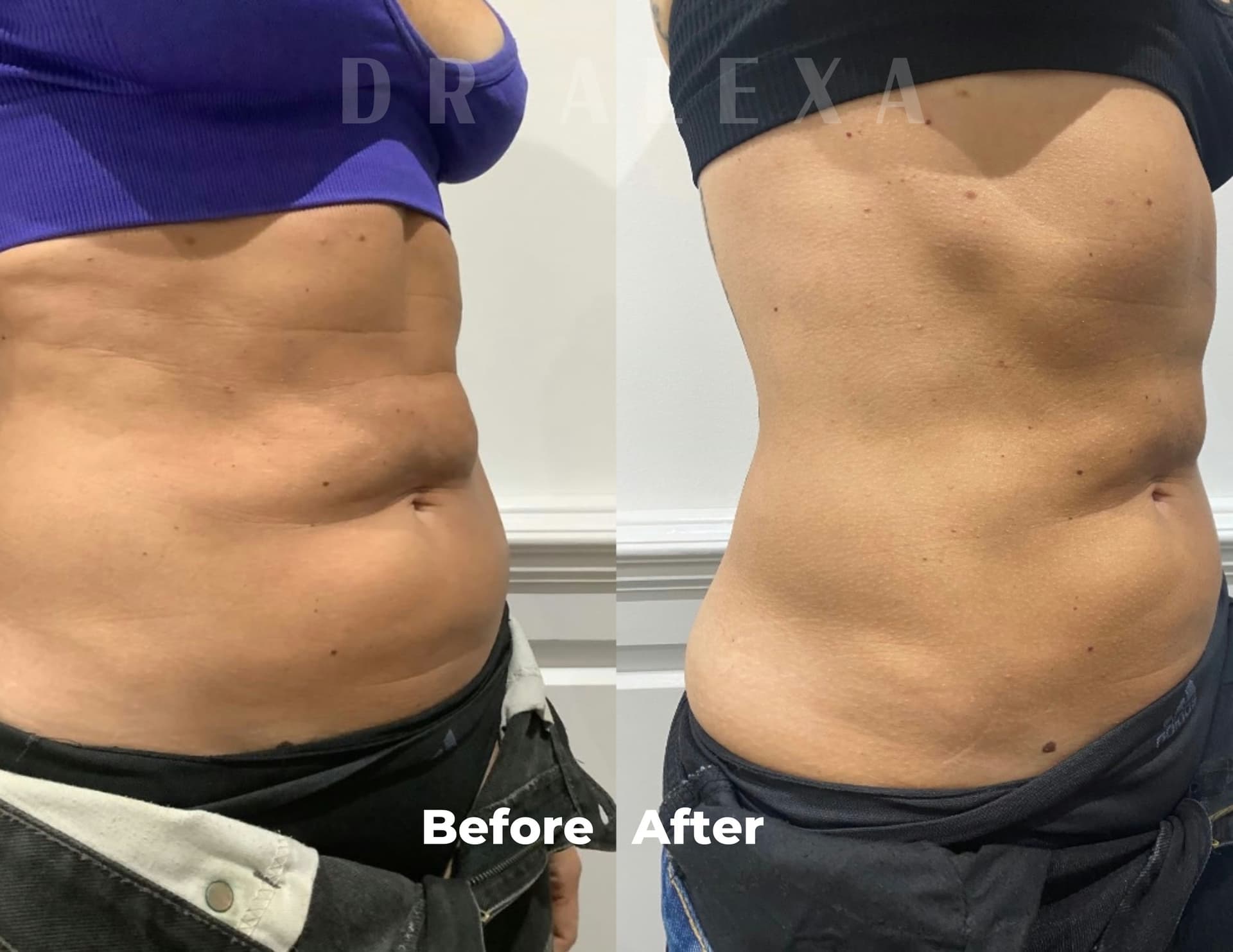Fat Dissolving before and after — case 3, Dr Alexa Mayfair