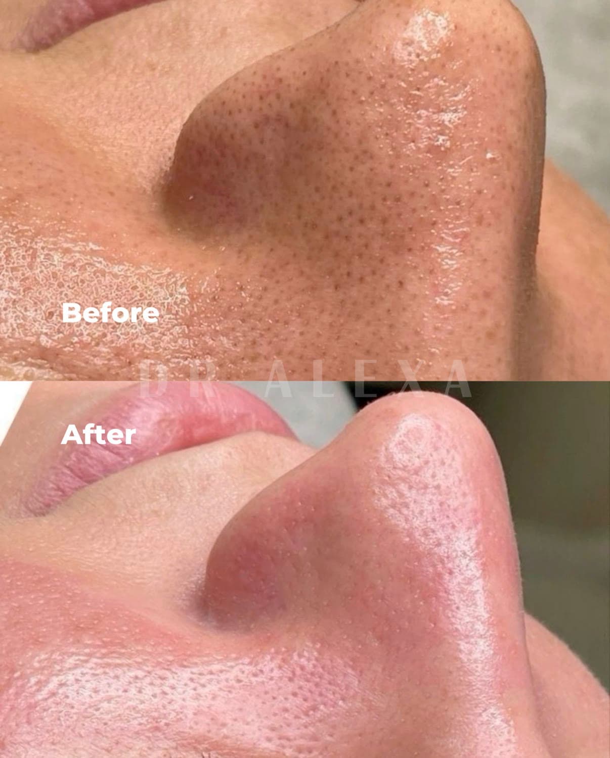 HydraFacial before and after — case 2, Dr Alexa Mayfair