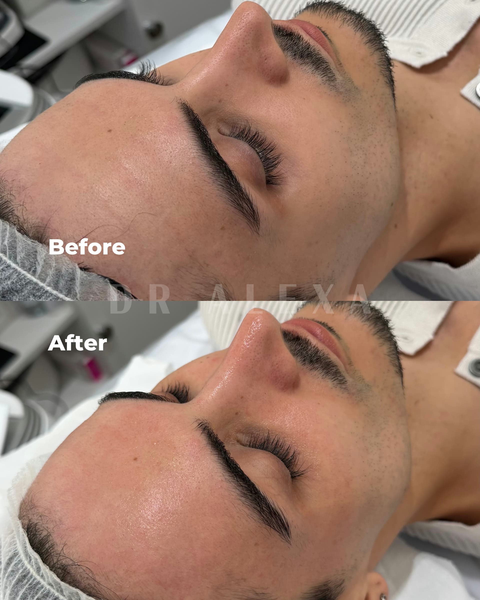 HydraFacial before and after — case 3, Dr Alexa Mayfair