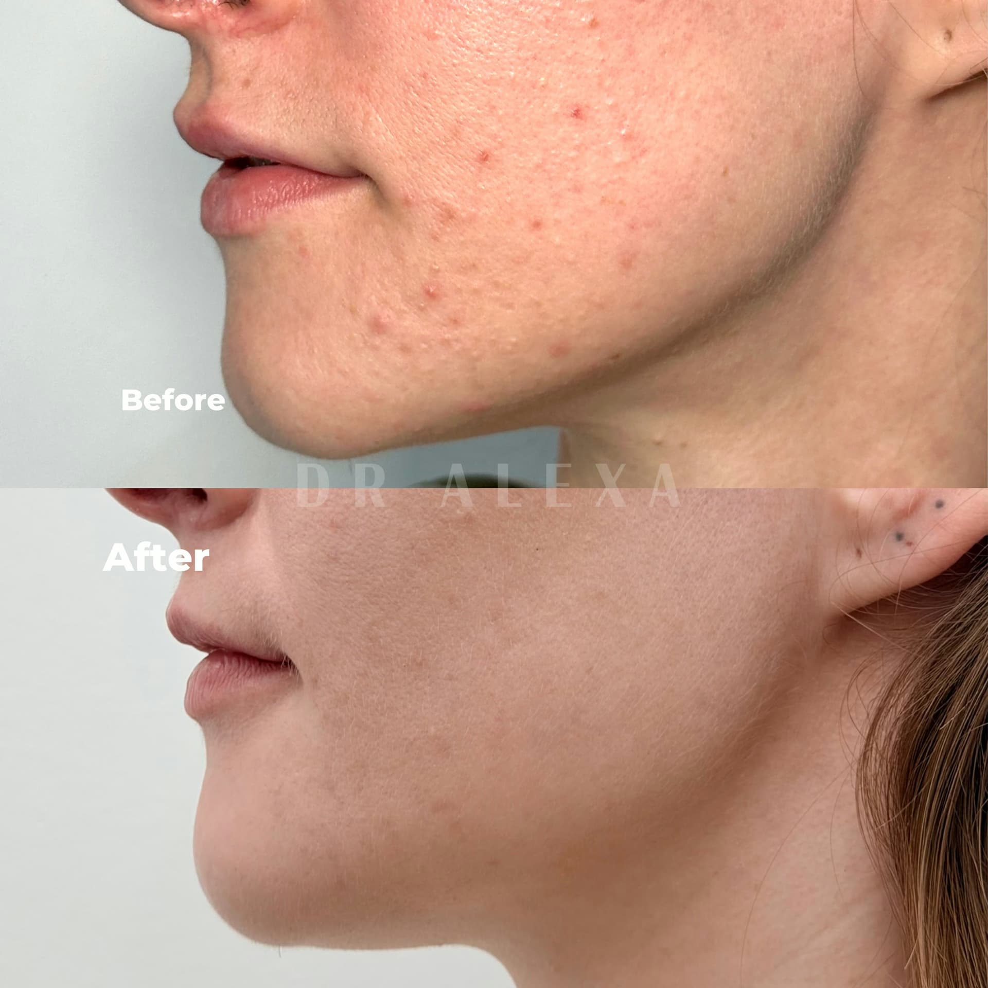 Medical Grade Skincare before and after — case 1, Dr Alexa Mayfair