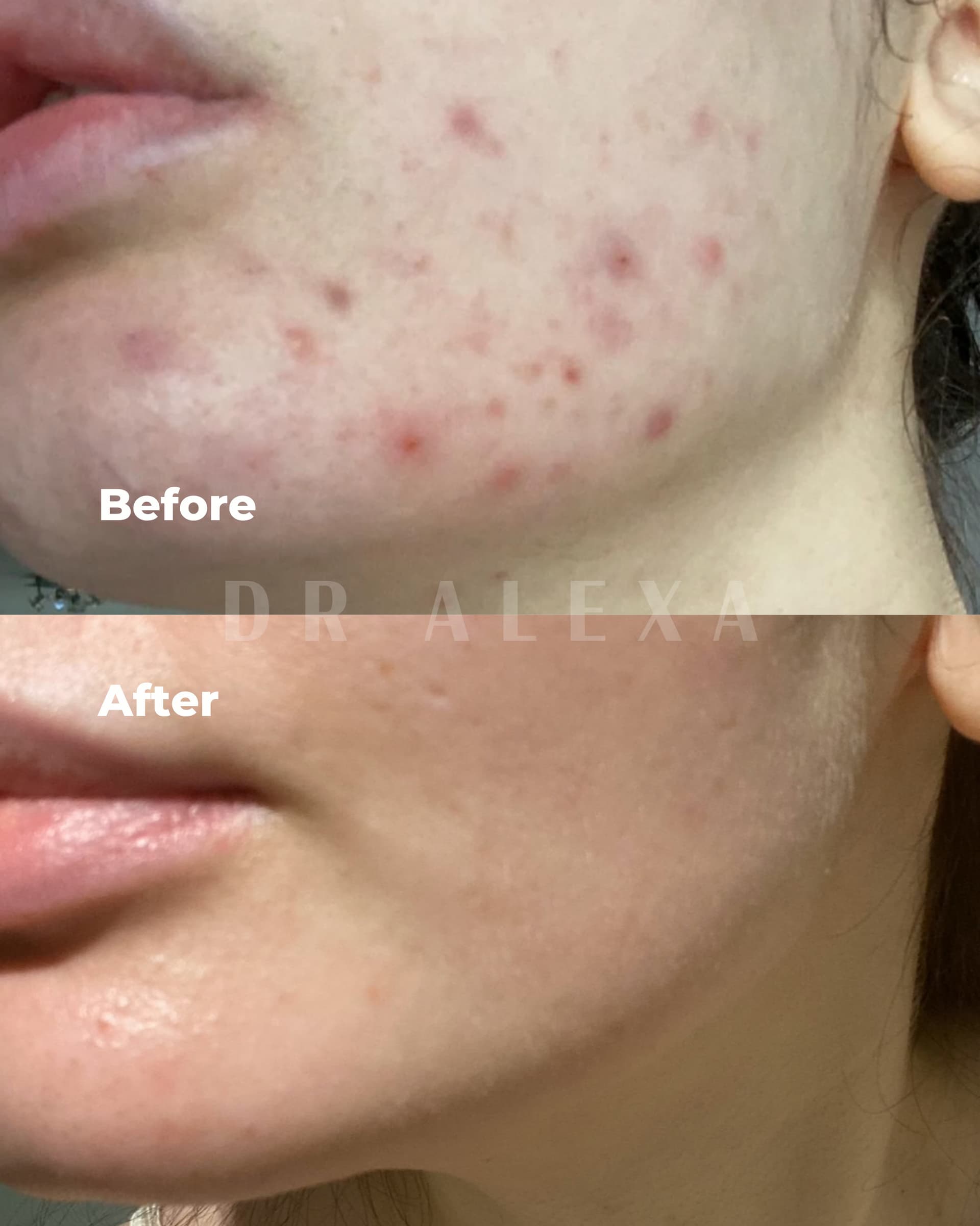 Medical Grade Skincare before and after — case 2, Dr Alexa Mayfair