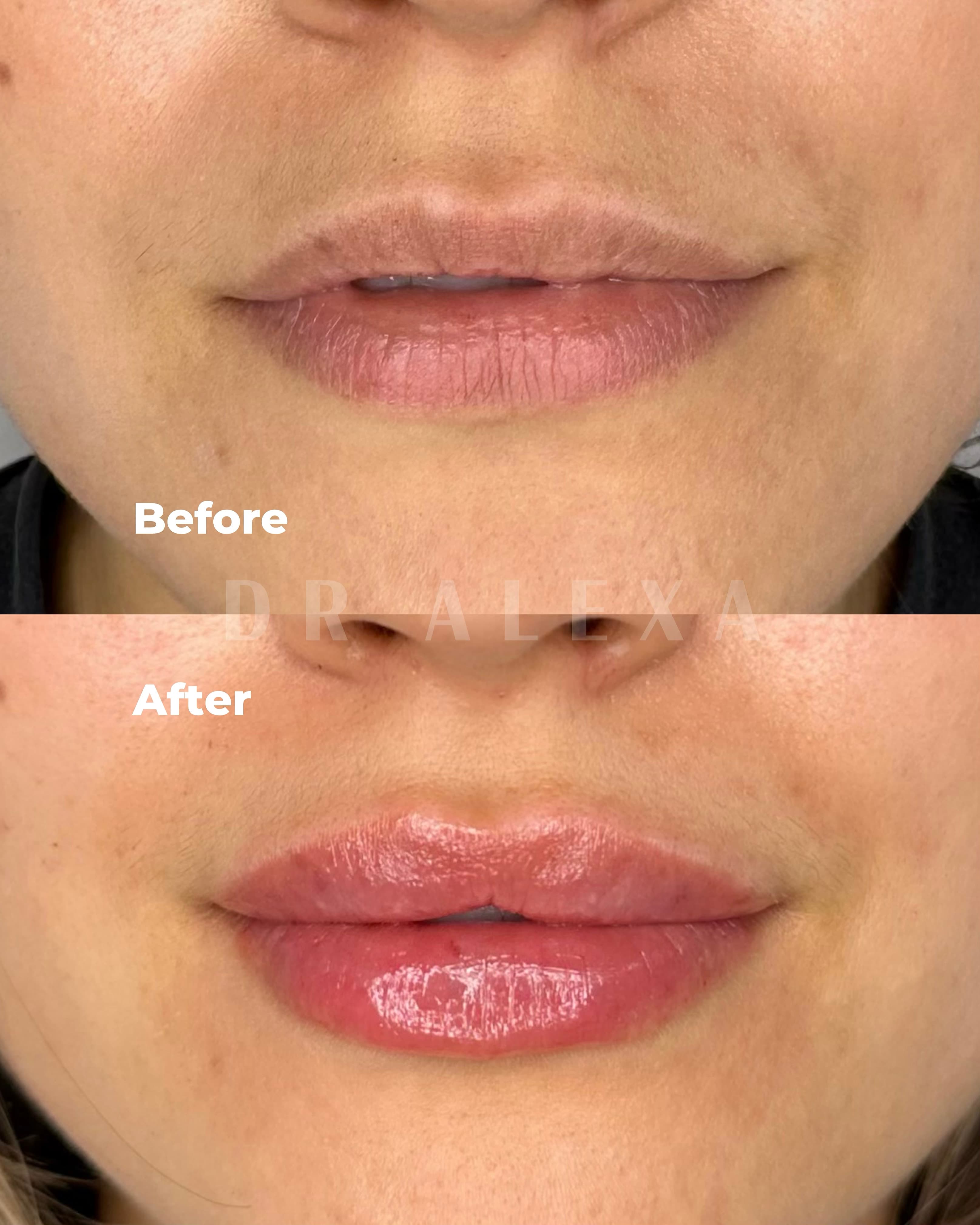 Lip Filler before and after — case 1, Dr Alexa Mayfair