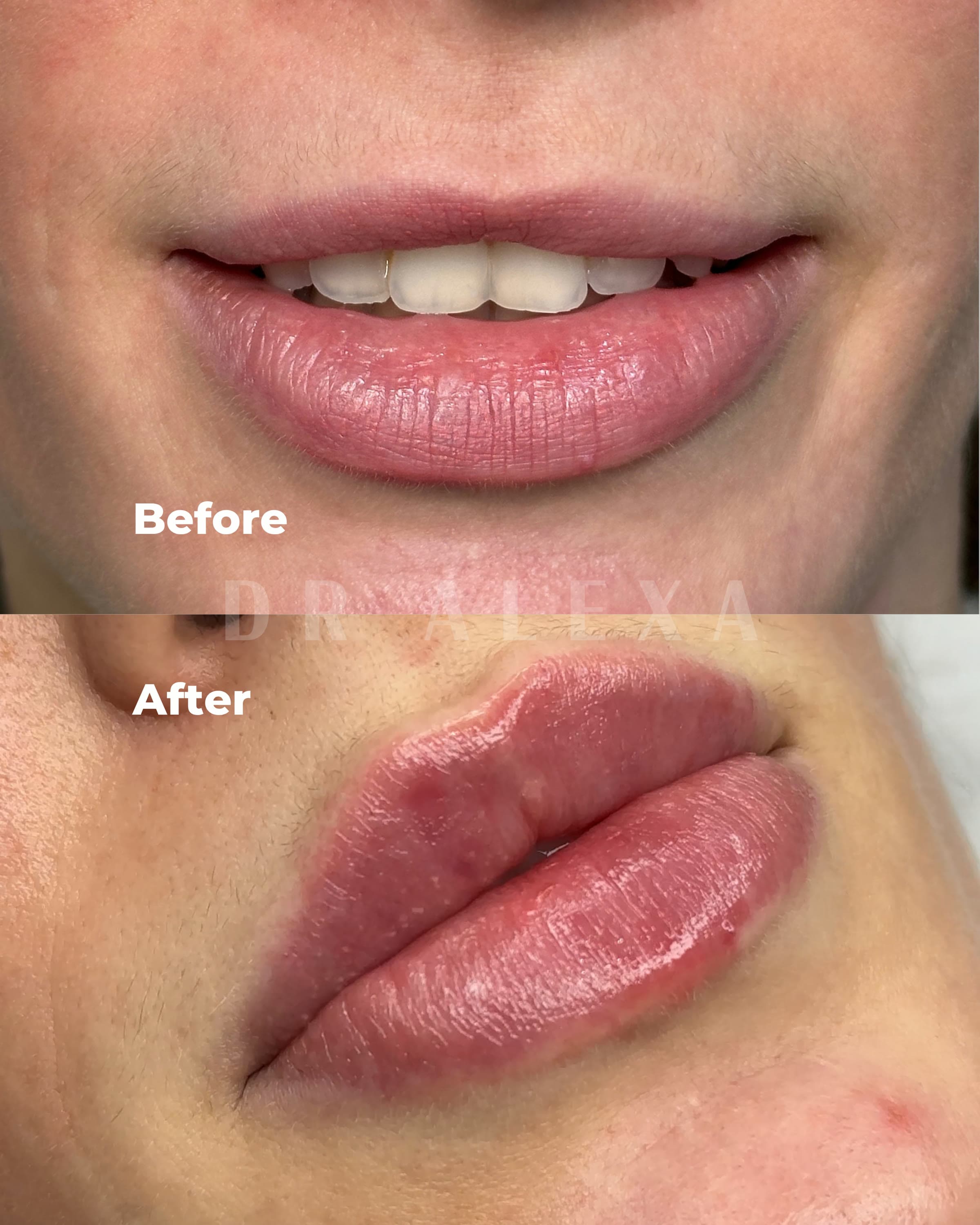 Lip Filler before and after — case 2, Dr Alexa Mayfair