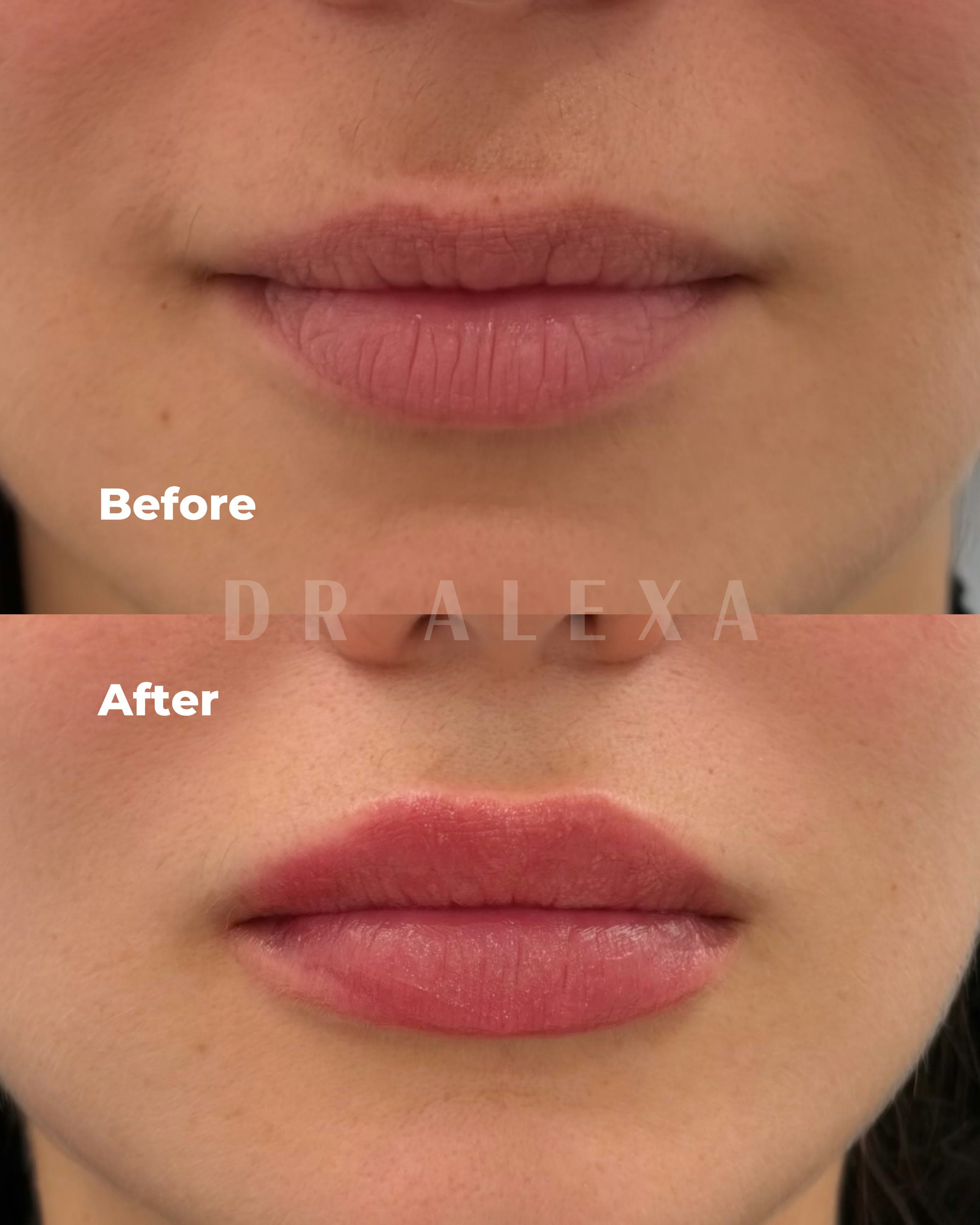 Lip Filler before and after — case 3, Dr Alexa Mayfair