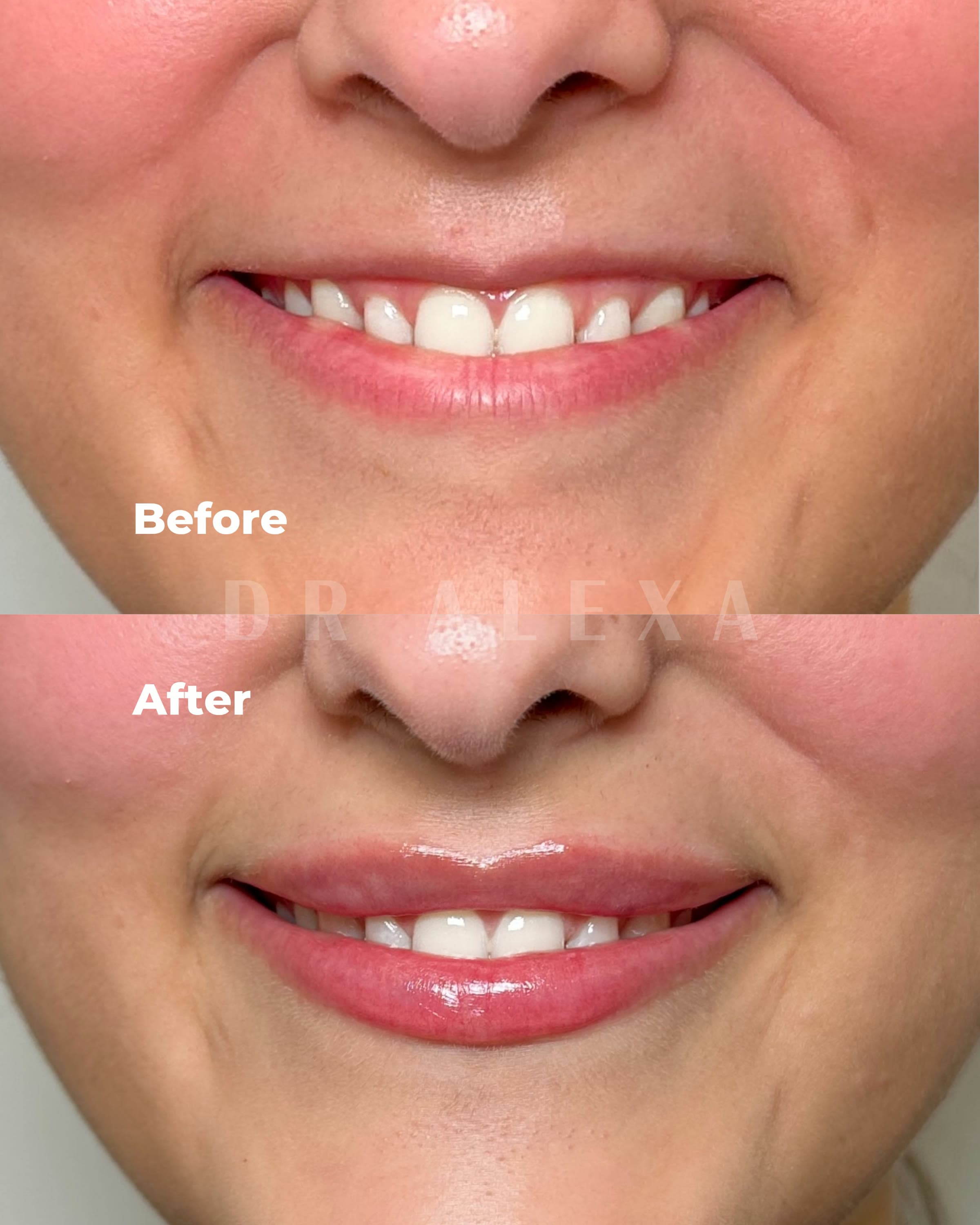 Lip Filler before and after — case 4, Dr Alexa Mayfair