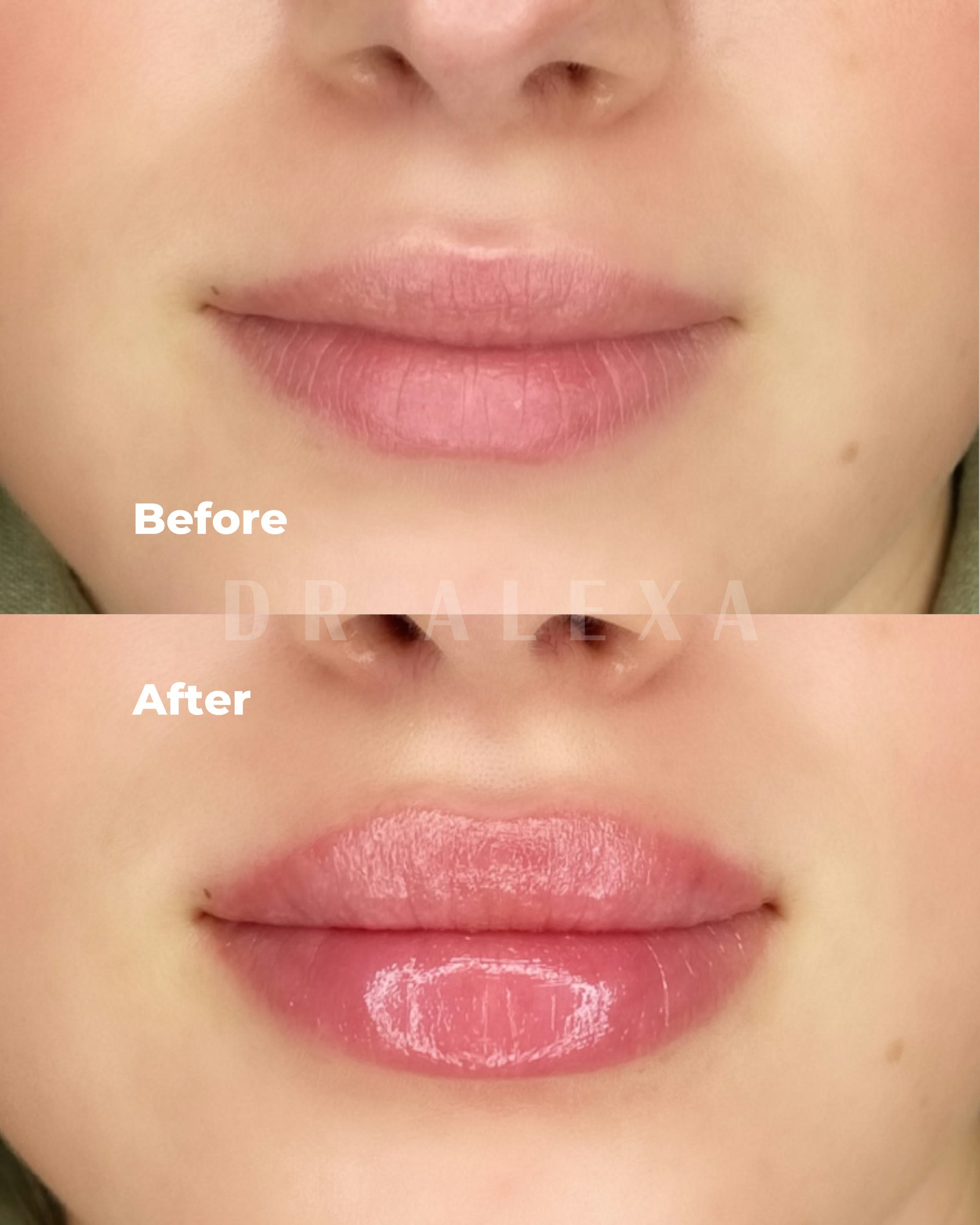 Lip Filler before and after — case 5, Dr Alexa Mayfair