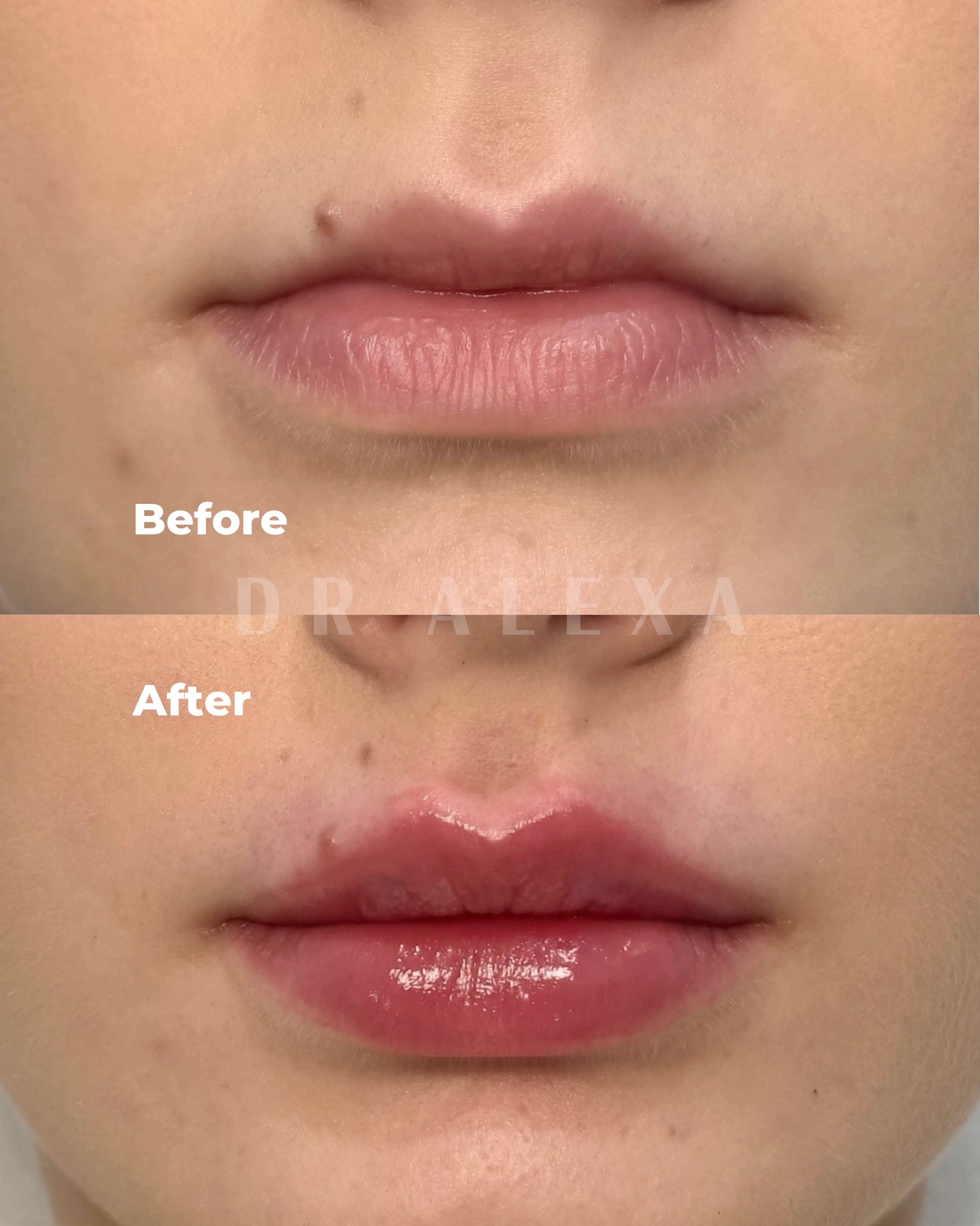 Lip Filler before and after — case 6, Dr Alexa Mayfair