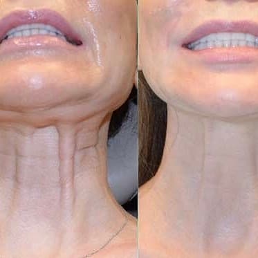 Nefertiti Neck Lift before and after — case 1, Dr Alexa Mayfair