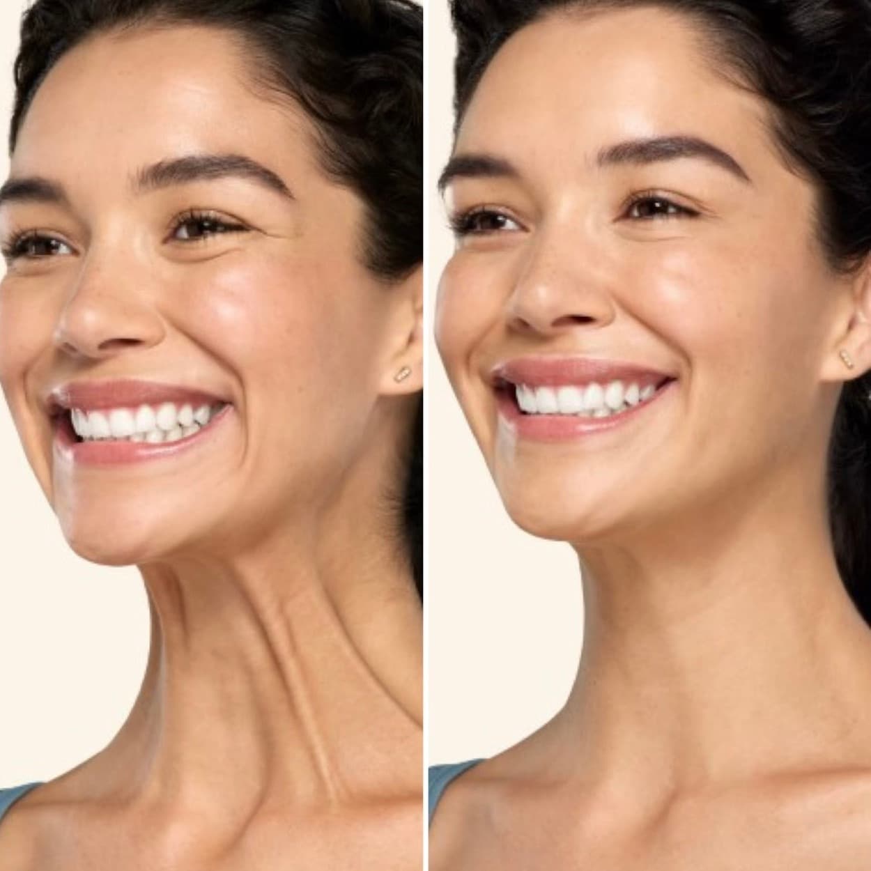 Nefertiti Neck Lift before and after — case 2, Dr Alexa Mayfair