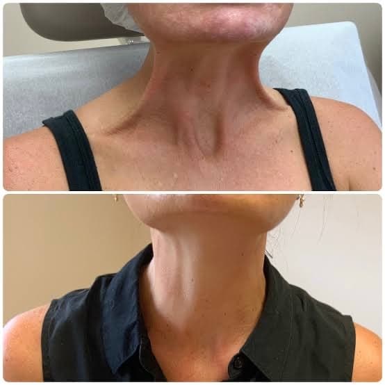 Nefertiti Neck Lift before and after — case 3, Dr Alexa Mayfair