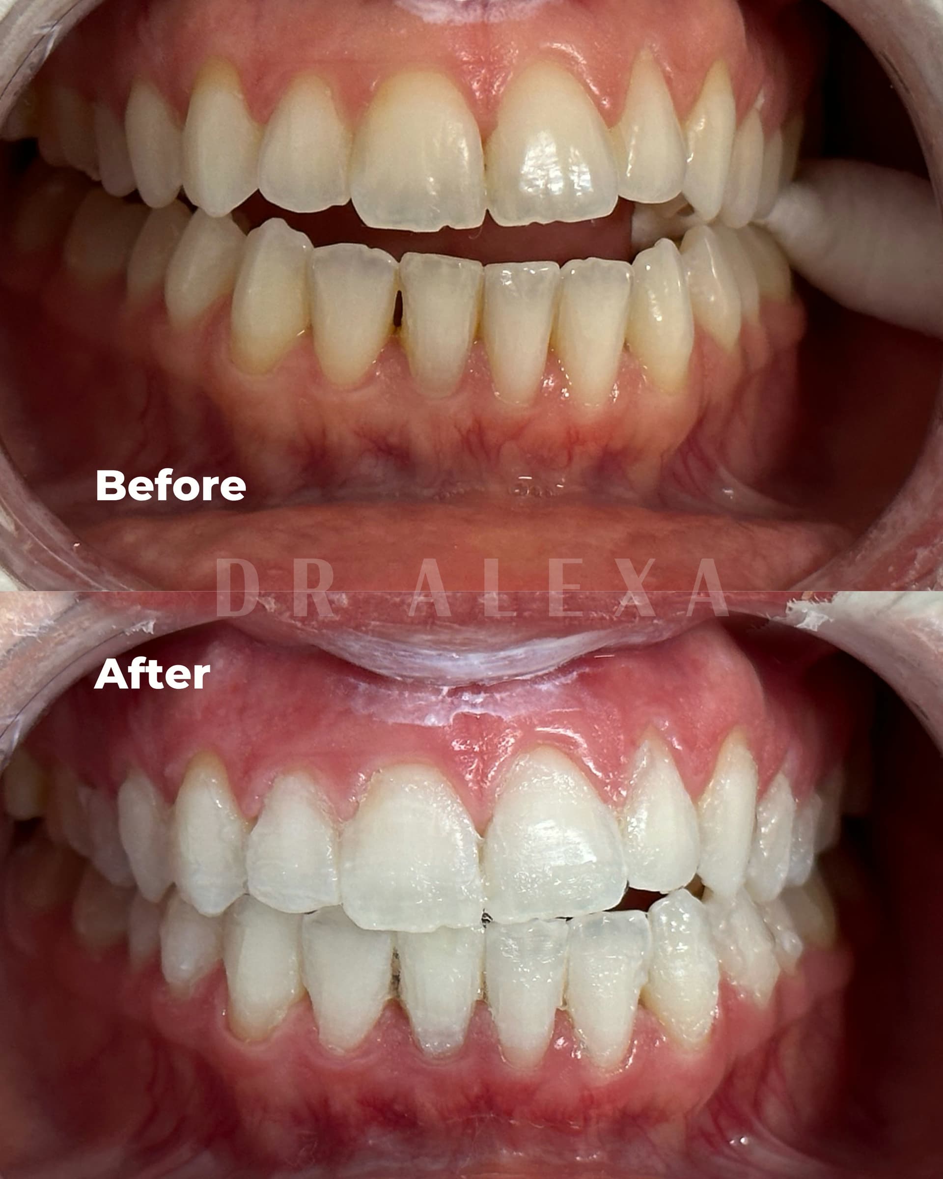 Philips ZOOM Teeth Whitening before and after — case 1, Dr Alexa Mayfair