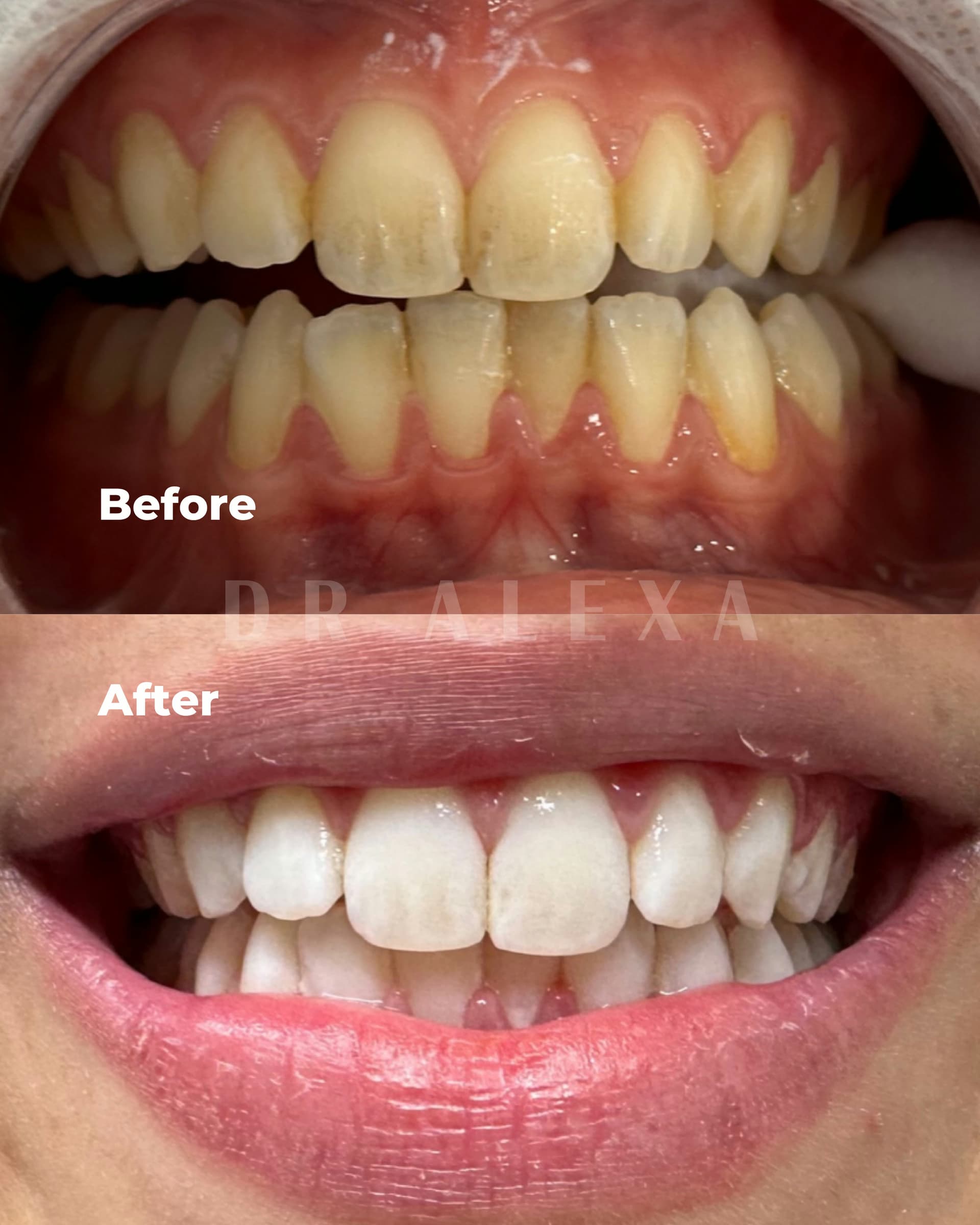 Philips ZOOM Teeth Whitening before and after — case 2, Dr Alexa Mayfair