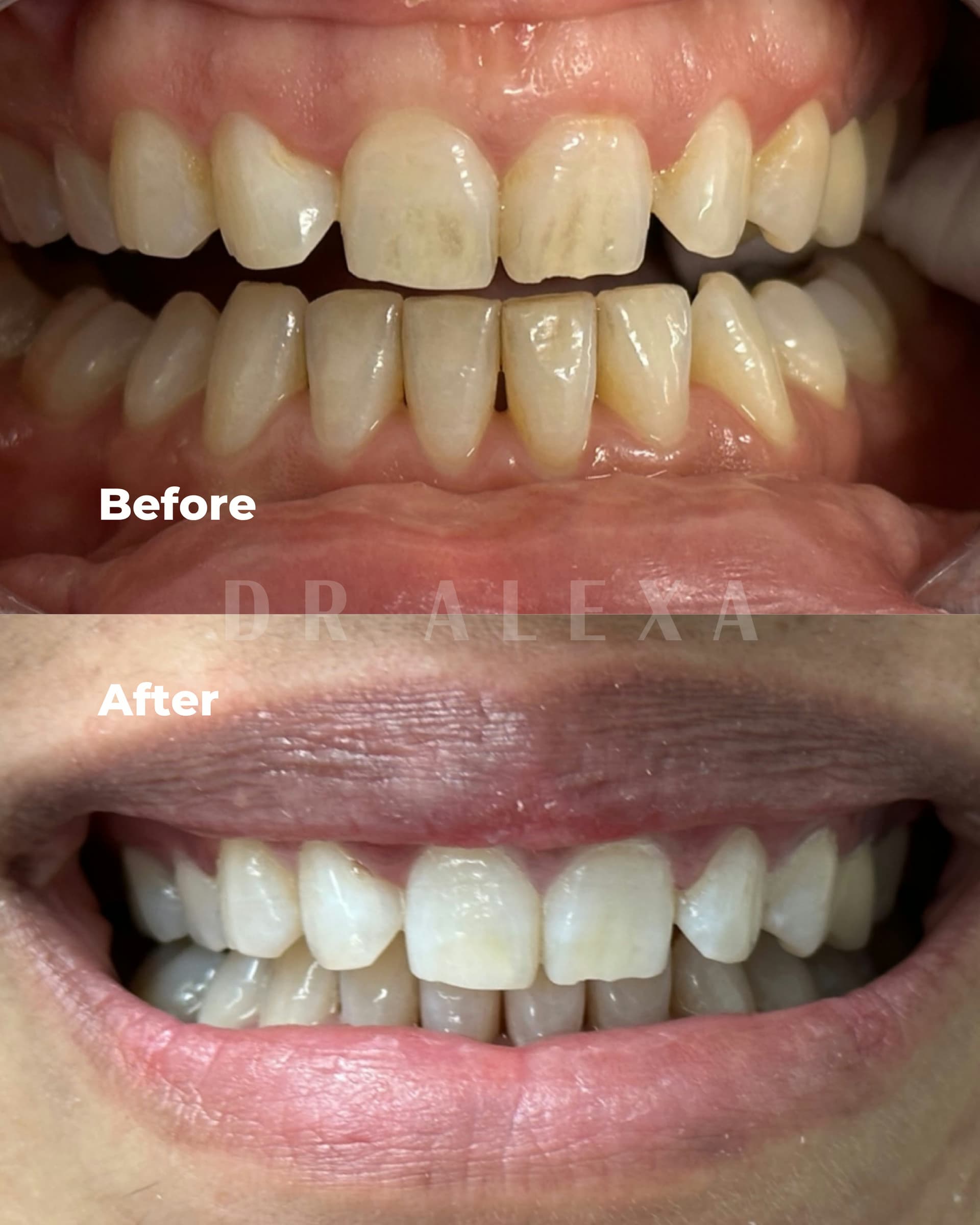 Philips ZOOM Teeth Whitening before and after — case 3, Dr Alexa Mayfair