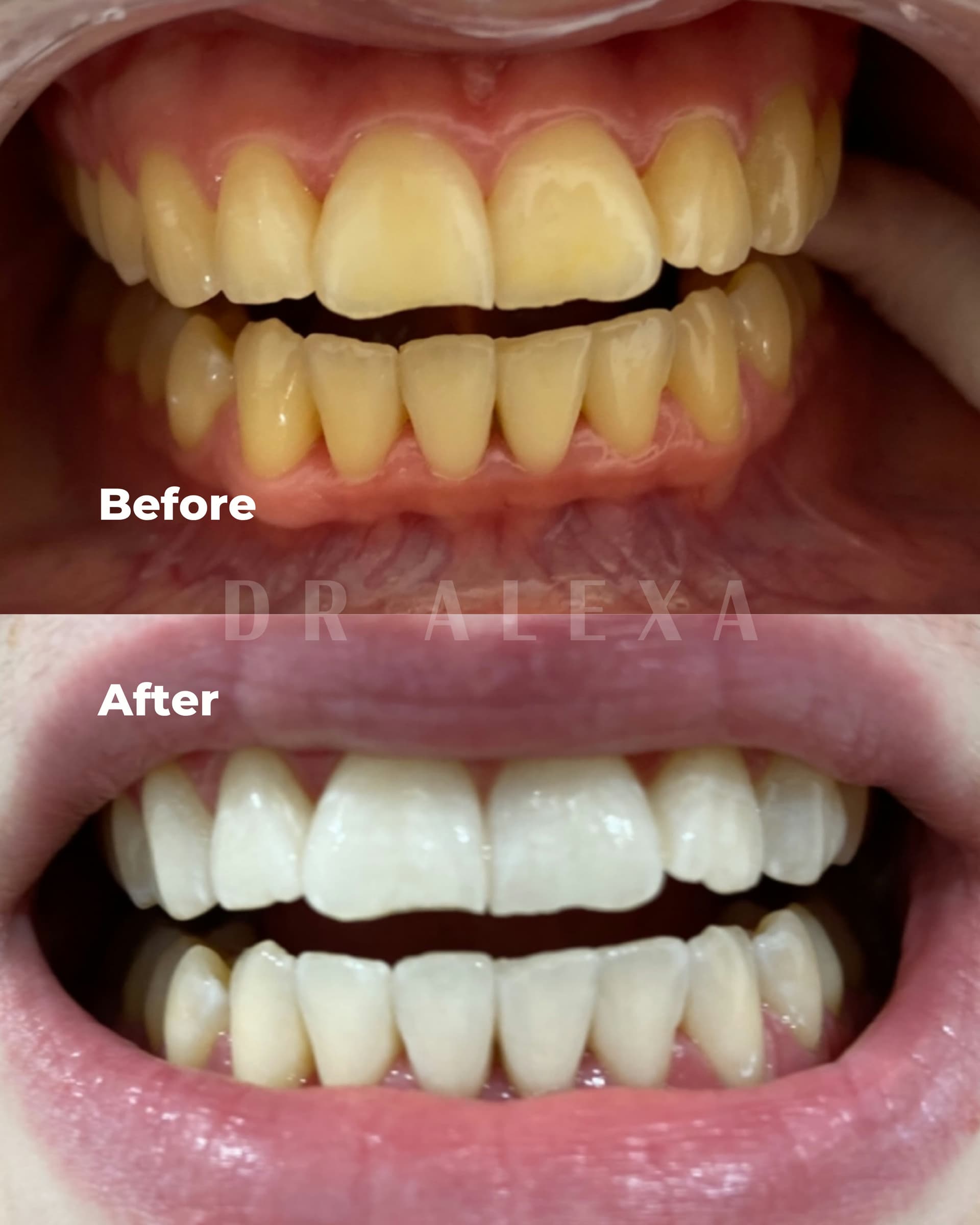 Philips ZOOM Teeth Whitening before and after — case 4, Dr Alexa Mayfair