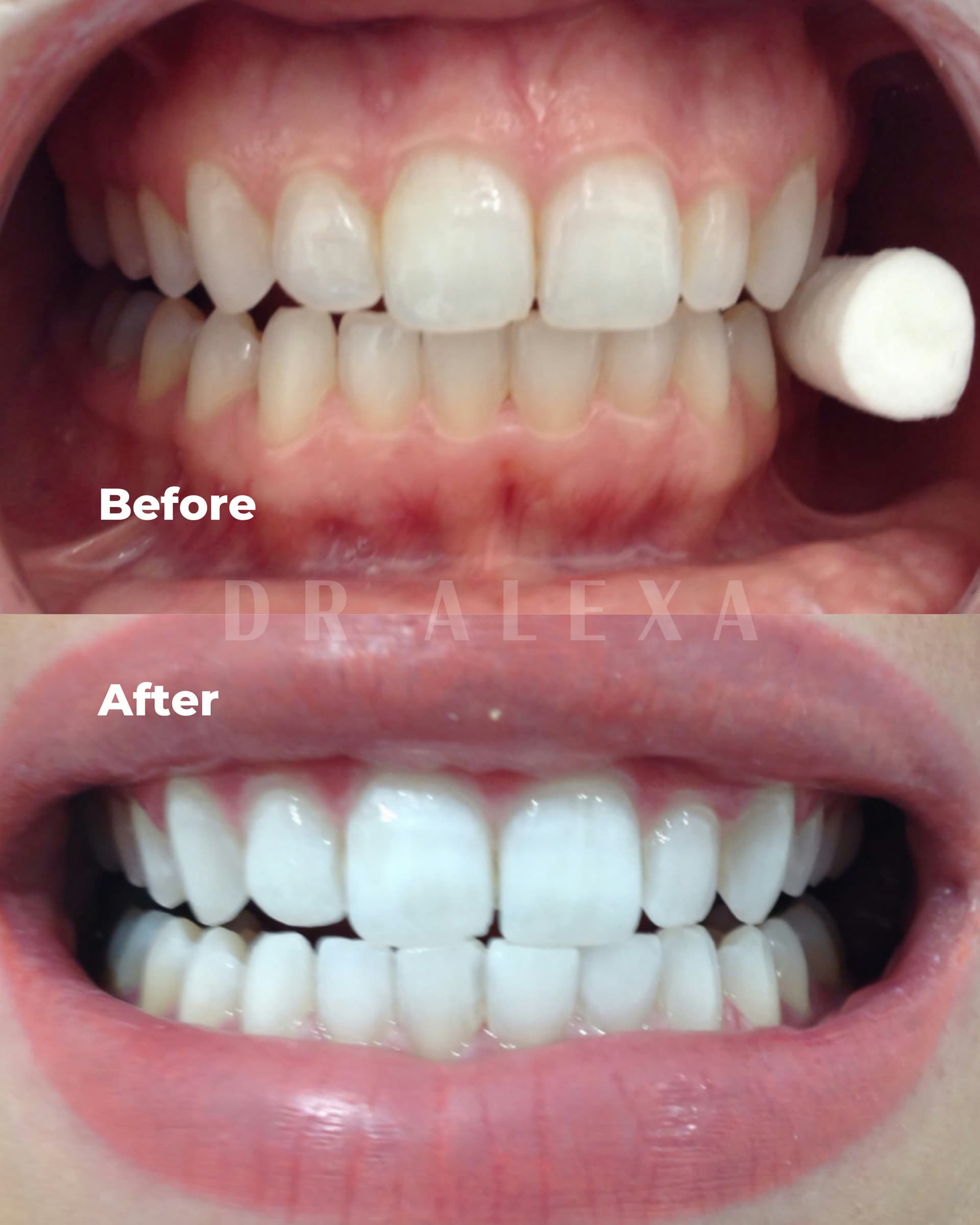 Philips ZOOM Teeth Whitening before and after — case 5, Dr Alexa Mayfair