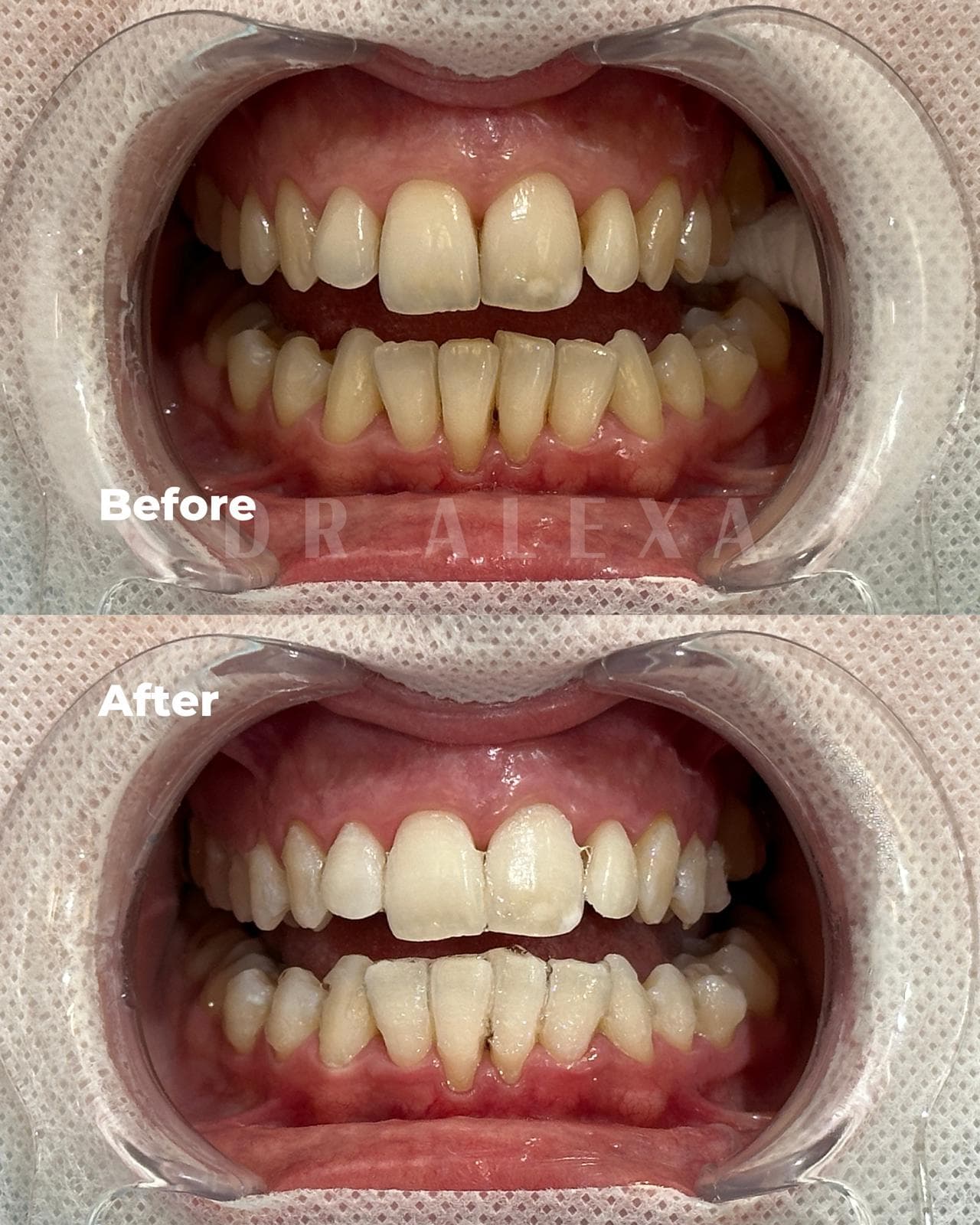 Philips ZOOM Teeth Whitening before and after — case 6, Dr Alexa Mayfair