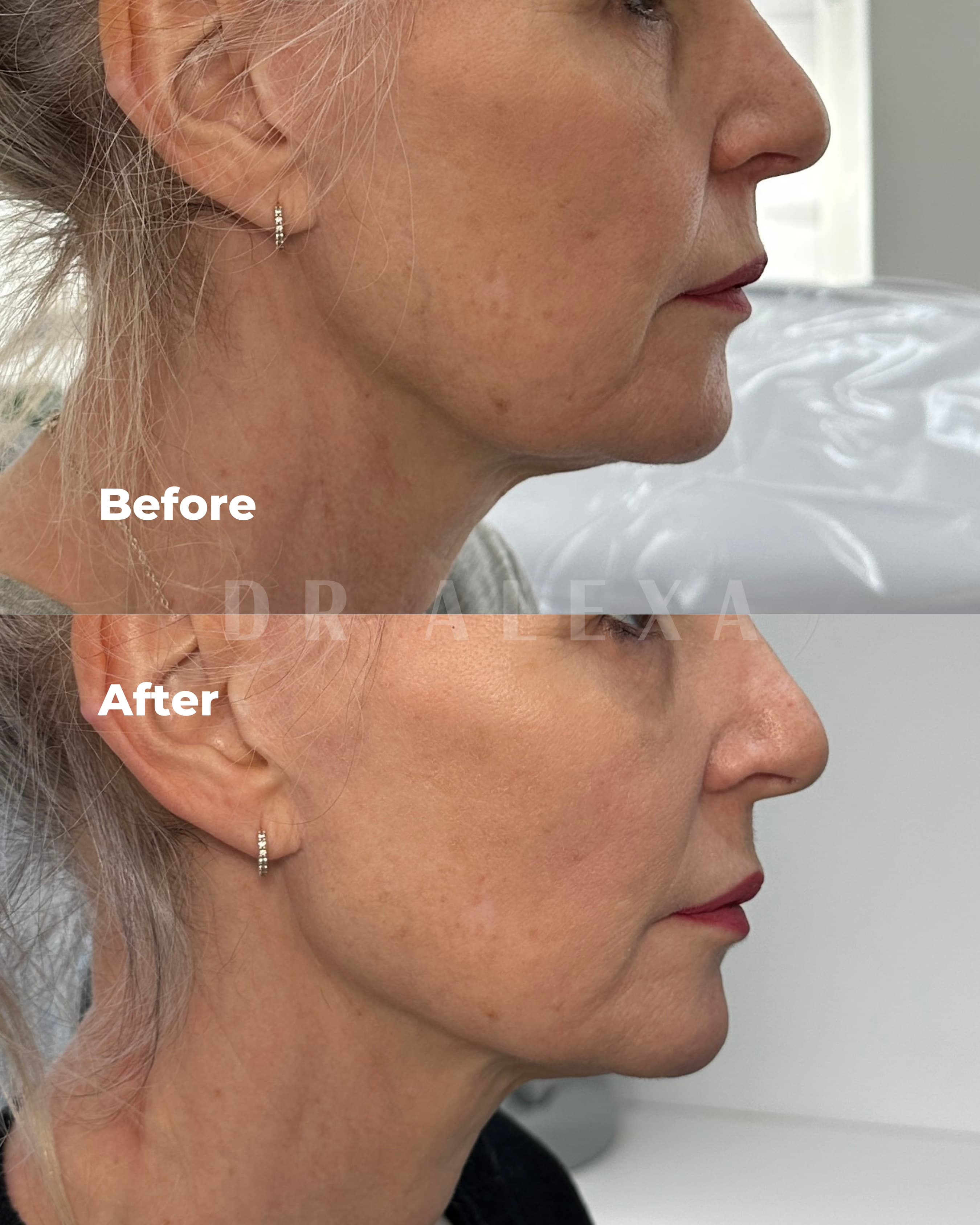 Sculptra before and after — case 3, Dr Alexa Mayfair