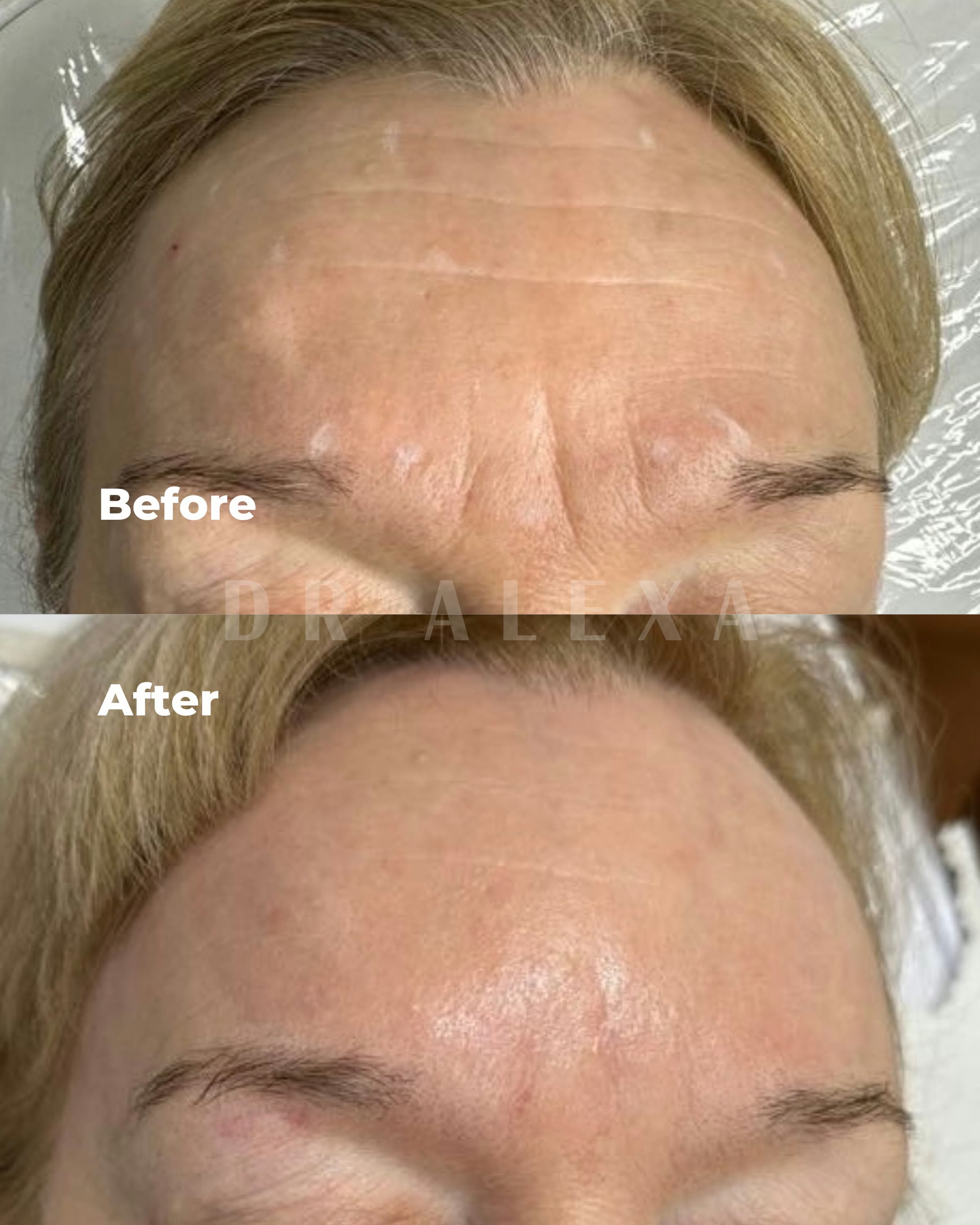 Skin Boosters before and after — case 3, Dr Alexa Mayfair