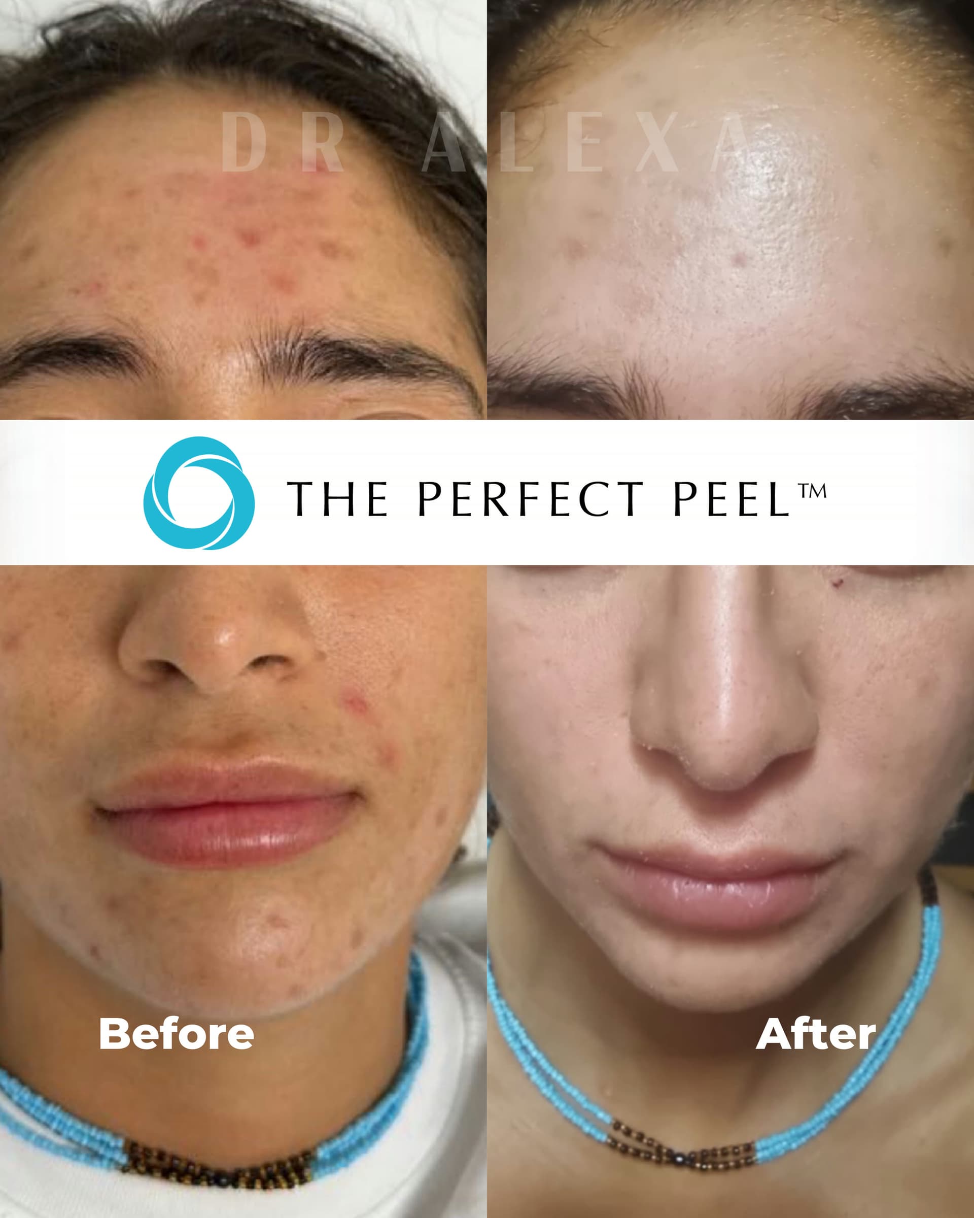 The Perfect Peel before and after — case 1, Dr Alexa Mayfair