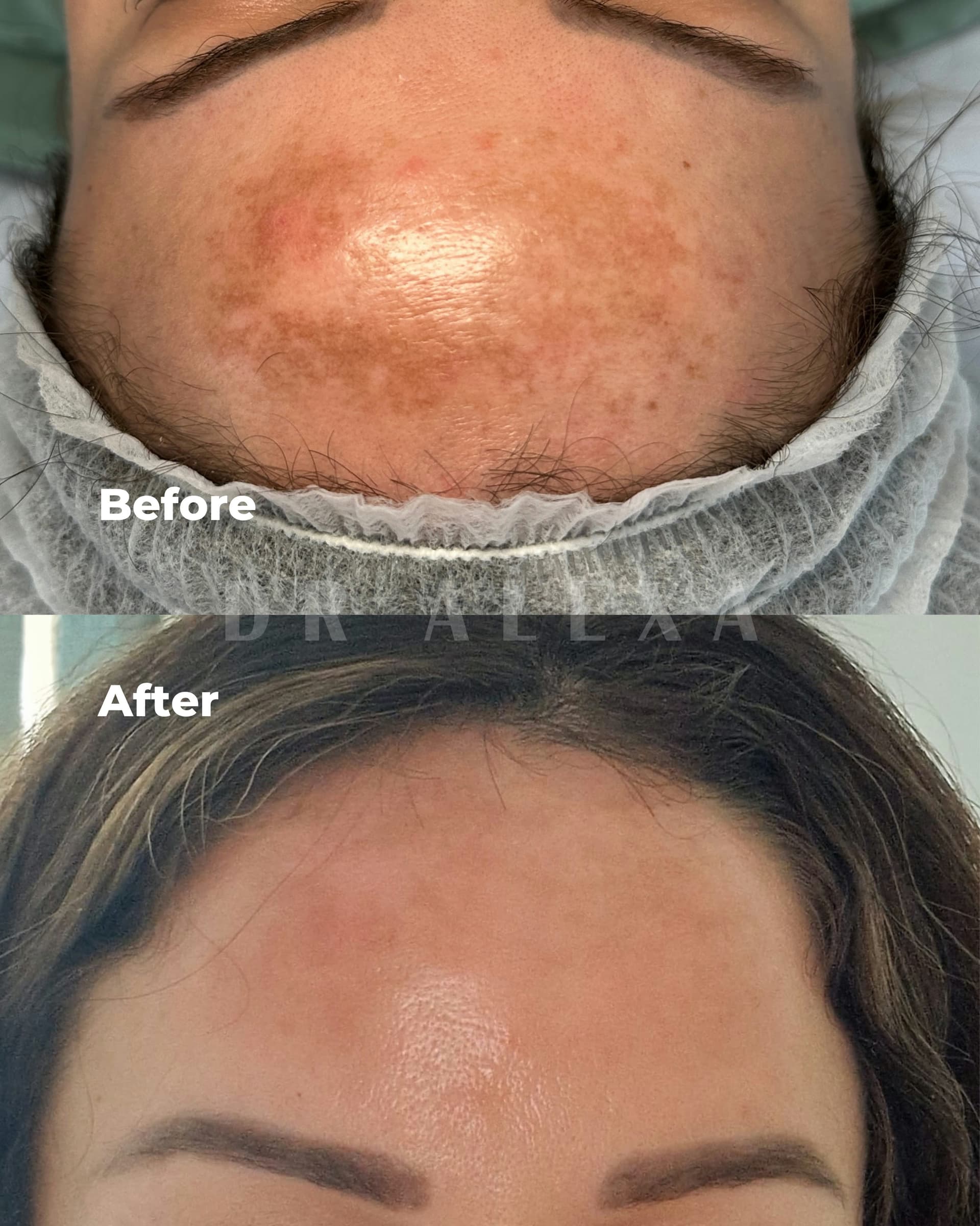 The Perfect Peel before and after — case 2, Dr Alexa Mayfair