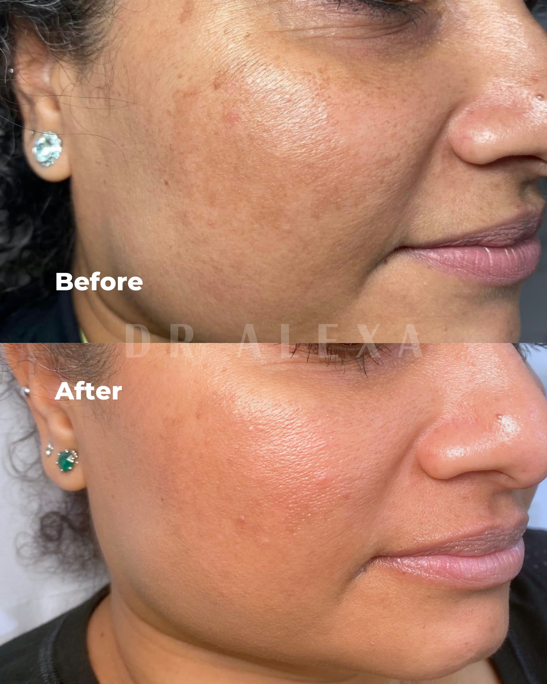 The Perfect Peel before and after — case 3, Dr Alexa Mayfair